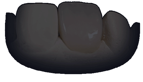 3D animation of a highly aesthetic dental crown rotating