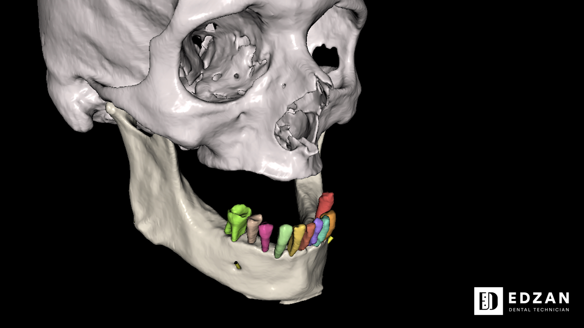Dental digital restoration work 1 by Edzan Lab