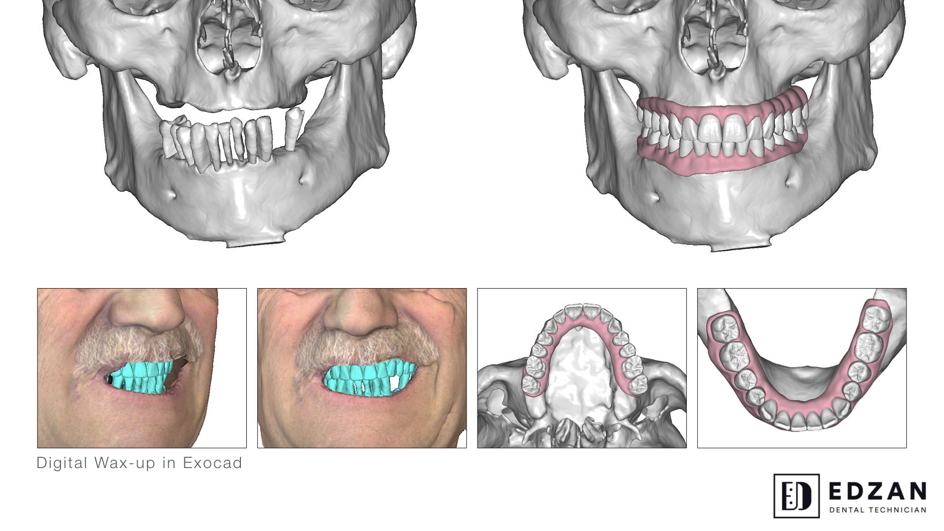 Dental digital restoration work 2 by Edzan Lab