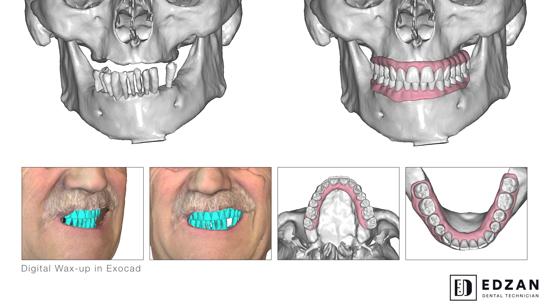 Dental digital restoration work 2 by Edzan Lab