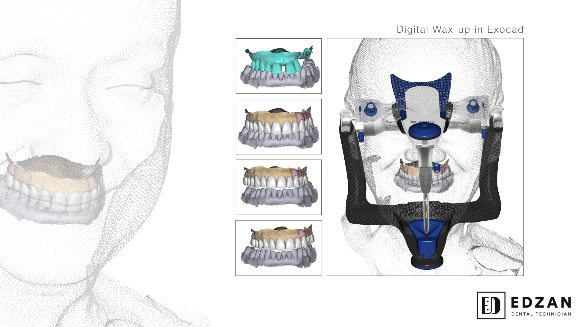 Dental digital restoration work 3 by Edzan Lab